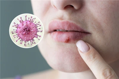 Chiết xuất chanh cho Herpes